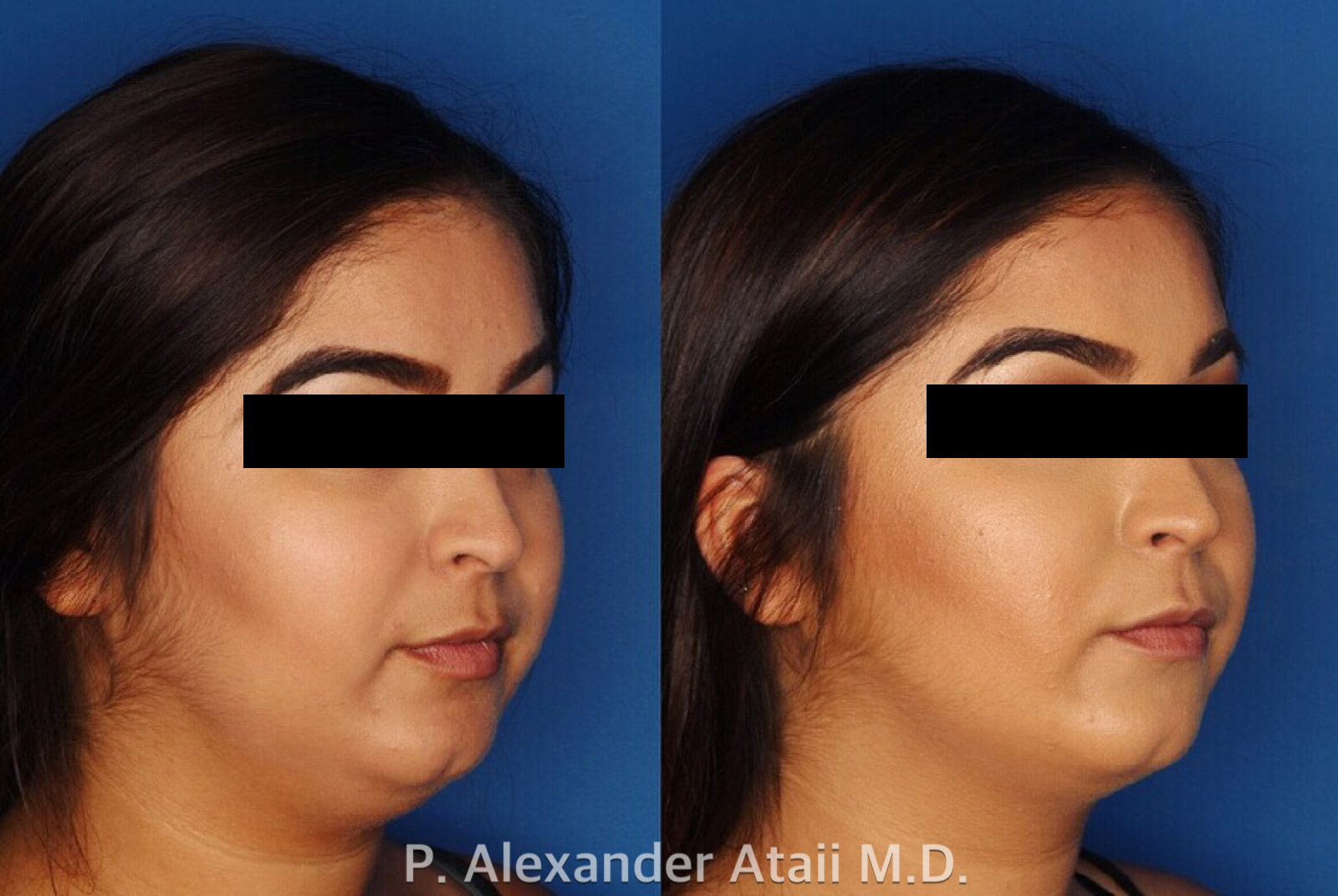 Kybella Gallery Before & After Gallery - Patient 24560814 - Image 3