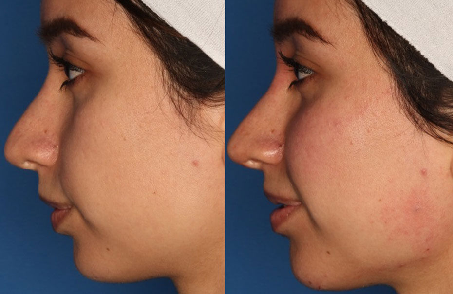 Juvederm Voluma Before & After Gallery - Patient 24560817 - Image 3