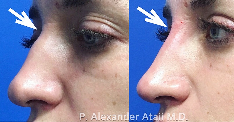 Non-Surgical Rhinoplasty Before & After Gallery - Patient 24560832 - Image 1