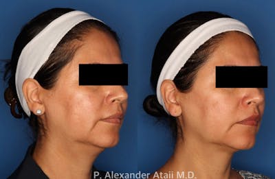 Kybella Gallery Before & After Gallery - Patient 24560838 - Image 1