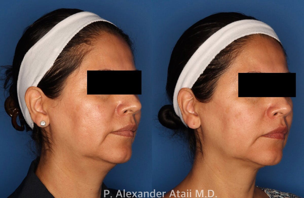 Kybella Before & After Gallery - Patient 24560838 - Image 1