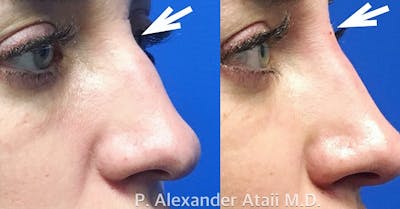 Non-Surgical Rhinoplasty Gallery Before & After Gallery - Patient 24560832 - Image 2