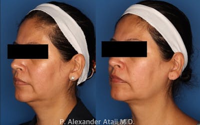Kybella Gallery Before & After Gallery - Patient 24560838 - Image 2