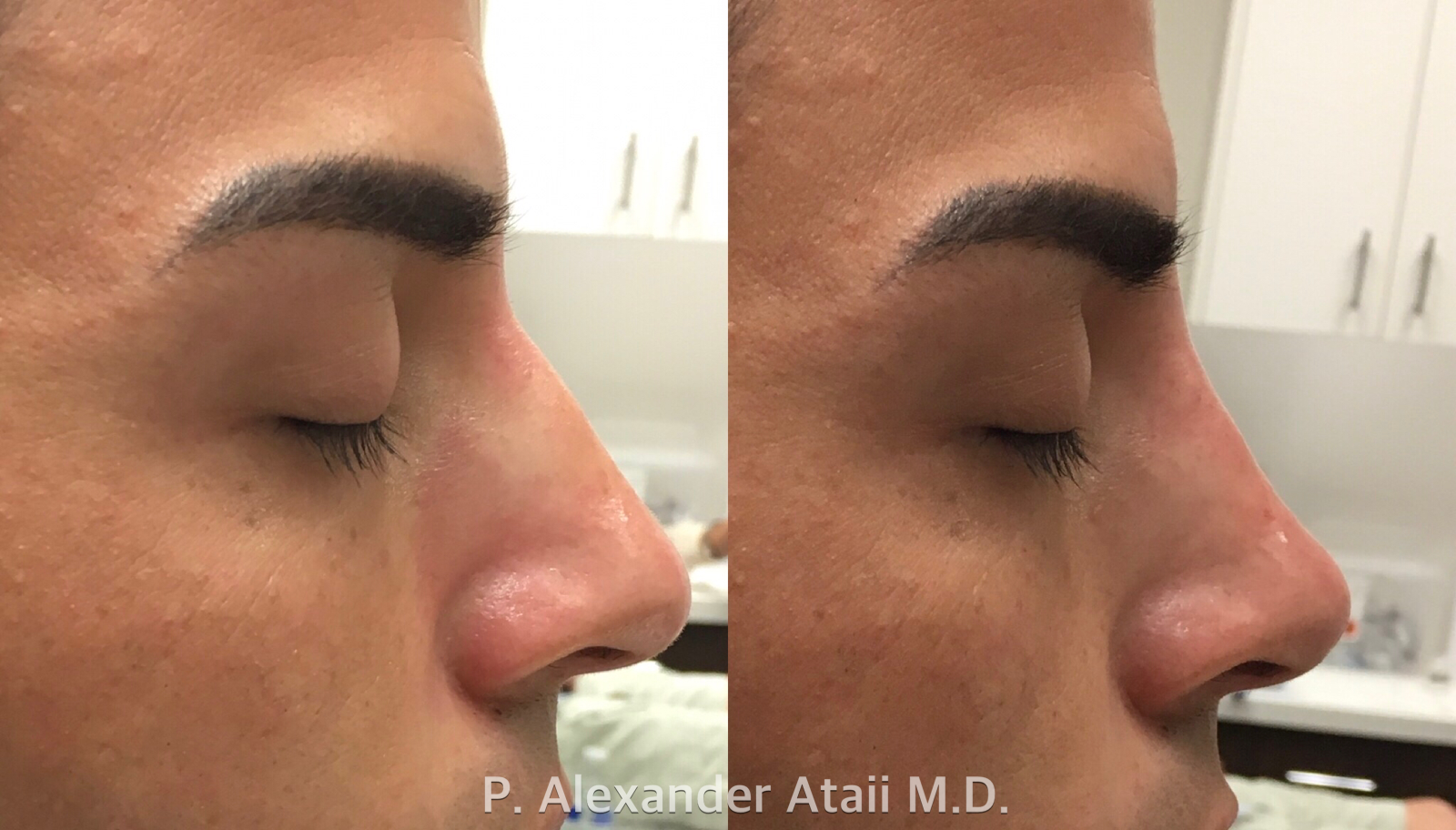 Non-Surgical Rhinoplasty Before & After Gallery - Patient 24560844 - Image 1