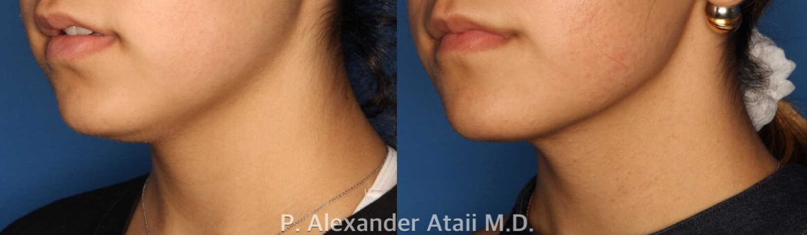 Kybella Before & After Gallery - Patient 24560851 - Image 1