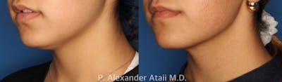 Kybella Gallery Before & After Gallery - Patient 24560851 - Image 1