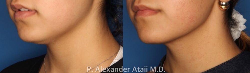 Kybella Before & After Gallery - Patient 24560851 - Image 1