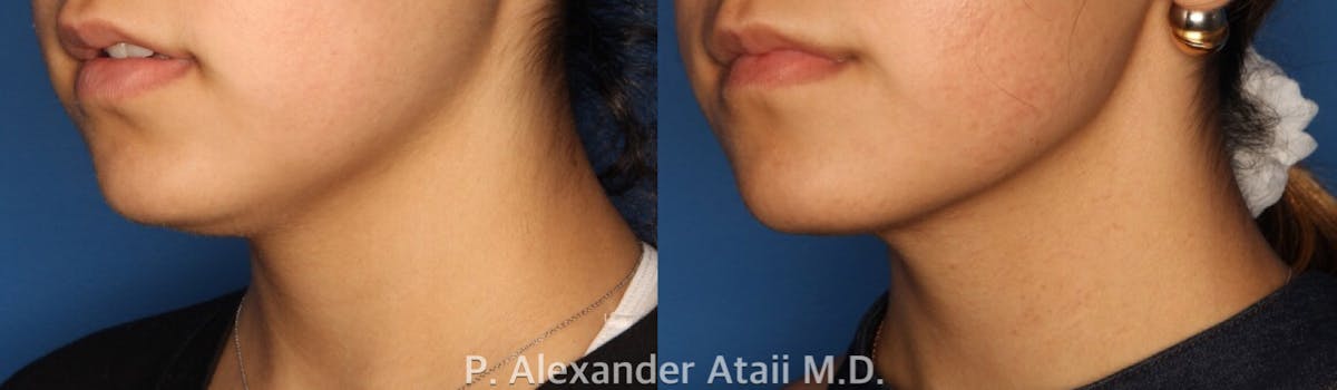 Kybella Before & After Gallery - Patient 24560851 - Image 1