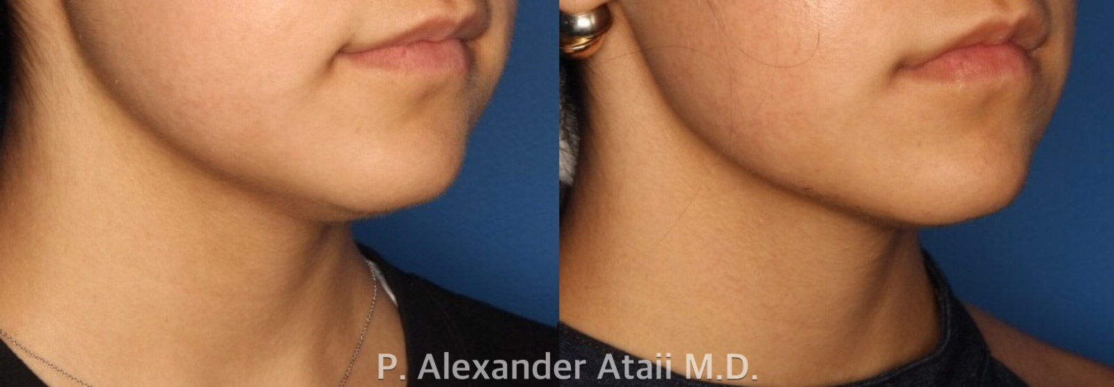 Kybella Gallery Before & After Gallery - Patient 24560851 - Image 2