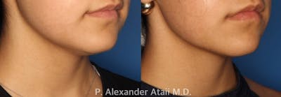Kybella Gallery Before & After Gallery - Patient 24560851 - Image 2