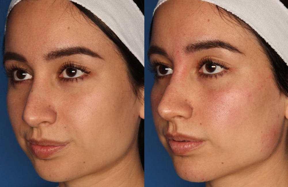Results from Non-Surgical Rhinoplasty in La Jolla