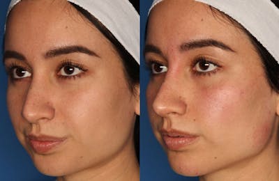 Non-Surgical Rhinoplasty Before & After Gallery - Patient 24560853 - Image 1