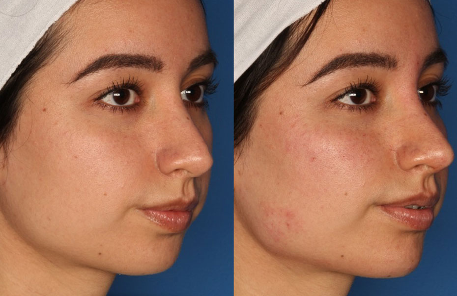 Non-Surgical Rhinoplasty Before & After Gallery - Patient 24560853 - Image 2