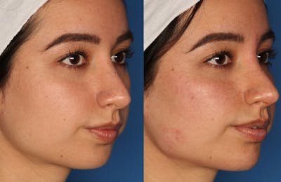 Non-Surgical Rhinoplasty Gallery Before & After Gallery - Patient 24560853 - Image 2