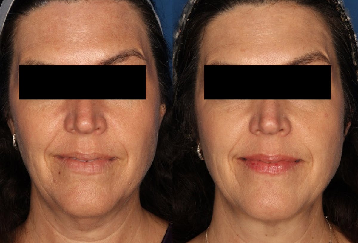 Kybella Gallery Before & After Gallery - Patient 24560855 - Image 1
