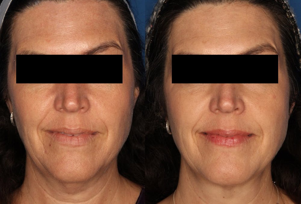 Kybella Before & After Gallery - Patient 24560855 - Image 1