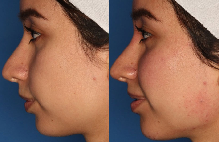 Non-Surgical Rhinoplasty Gallery Before & After Gallery - Patient 24560853 - Image 3