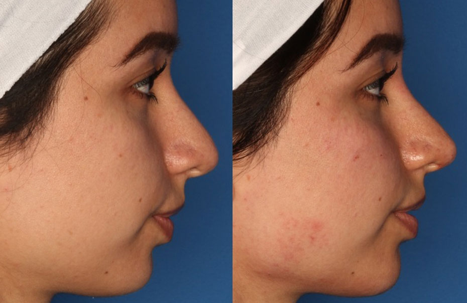 Non-Surgical Rhinoplasty Gallery Before & After Gallery - Patient 24560853 - Image 4