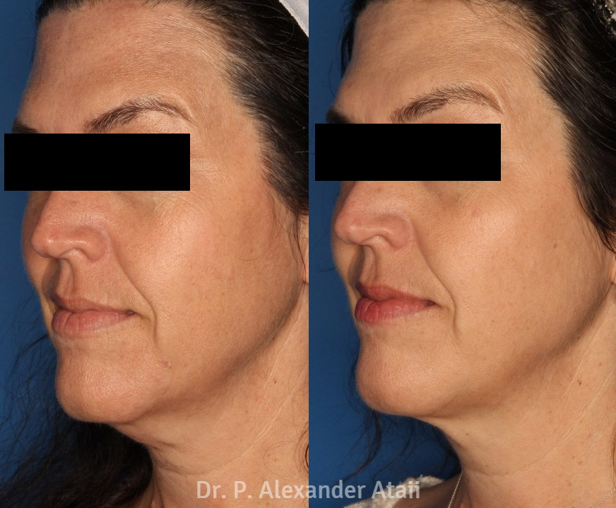 Kybella Gallery Before & After Gallery - Patient 24560855 - Image 2