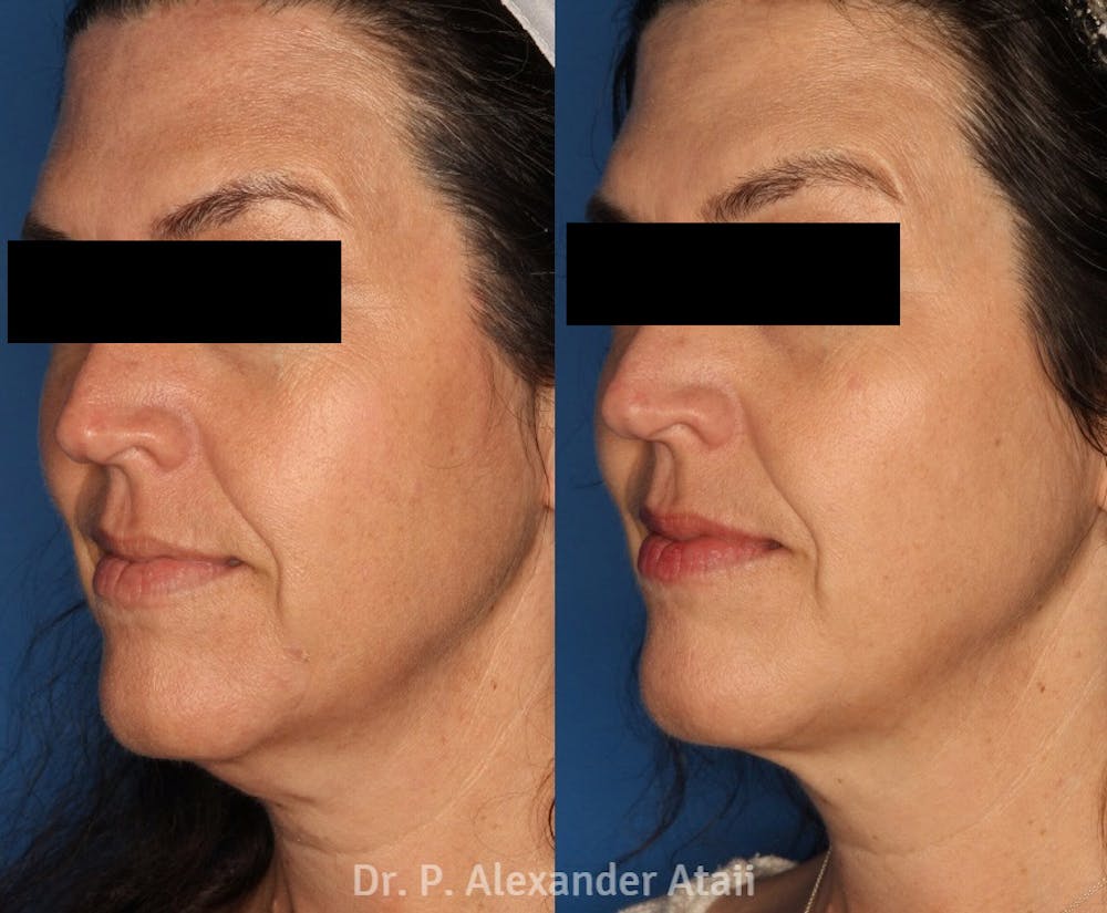Kybella Before & After Gallery - Patient 24560855 - Image 2