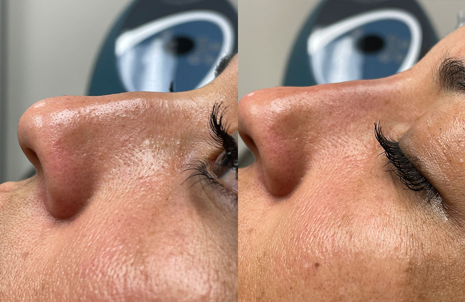 Non-Surgical Rhinoplasty Before & After Gallery - Patient 24560859 - Image 1