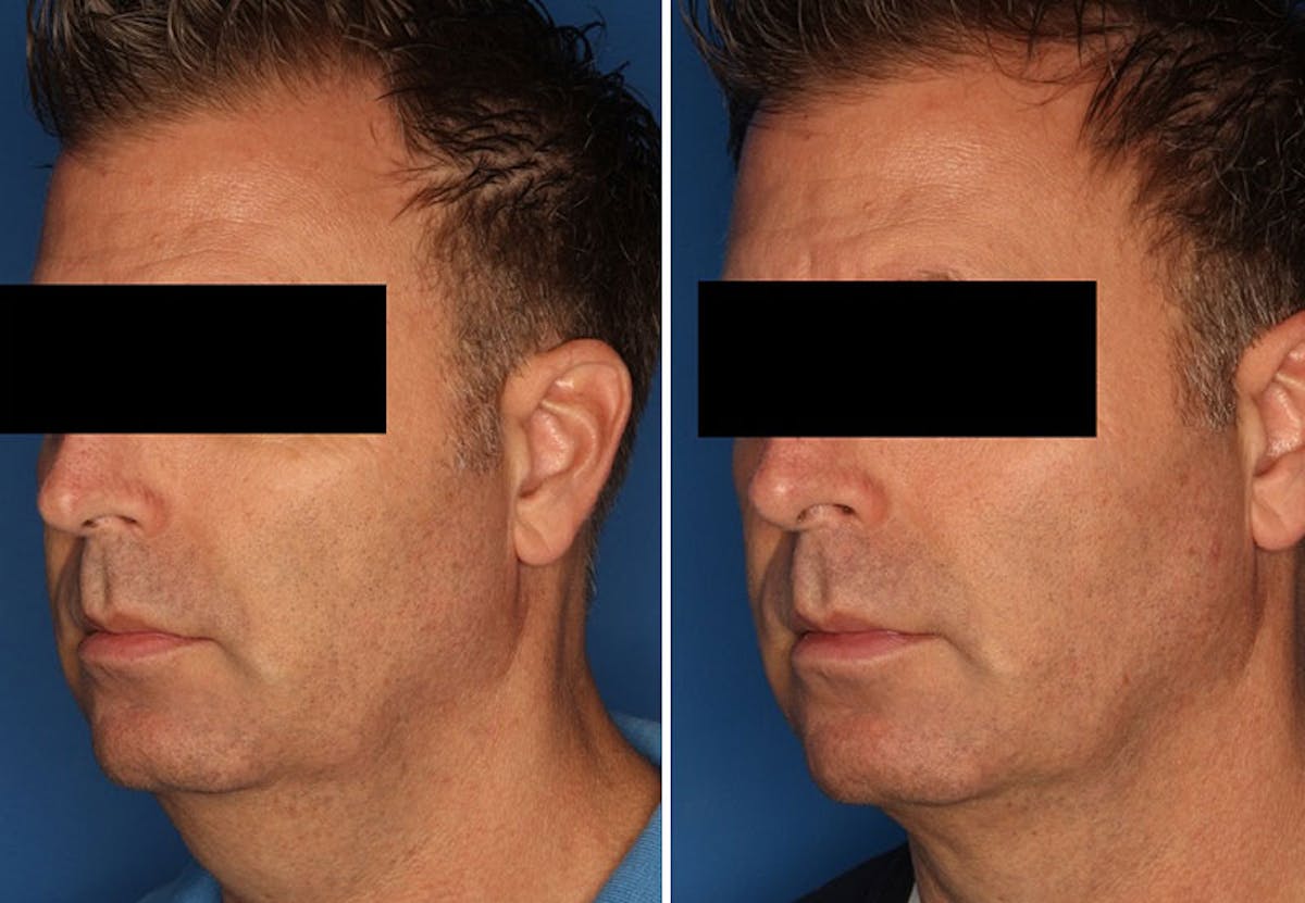 Kybella Gallery Before & After Gallery - Patient 24560858 - Image 1