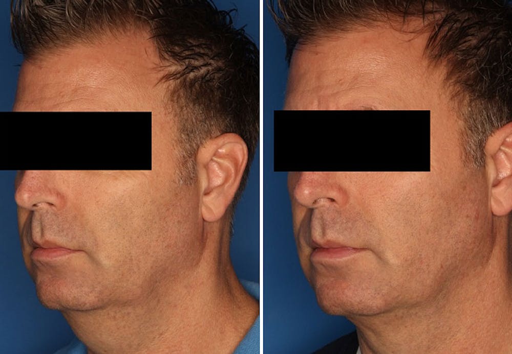 Kybella Before & After Gallery - Patient 24560858 - Image 1