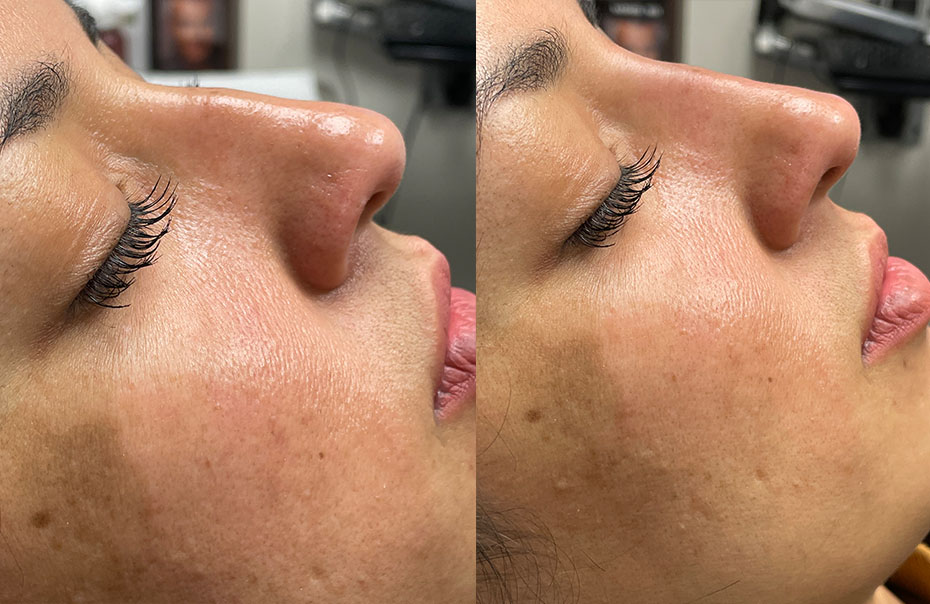 Non-Surgical Rhinoplasty Before & After Gallery - Patient 24560859 - Image 2