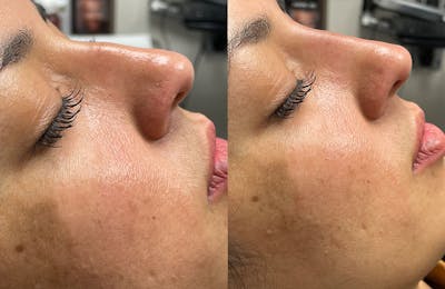 Non-Surgical Rhinoplasty Gallery Before & After Gallery - Patient 24560859 - Image 2