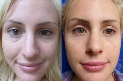 Dermal Fillers Gallery Before & After Gallery - Patient 178602 - Image 1