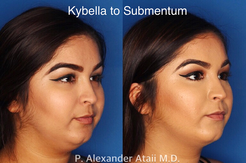 Kybella Gallery Before & After Gallery - Patient 24560865 - Image 1