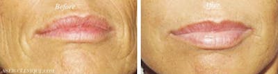 Dermal Fillers Gallery Before & After Gallery - Patient 203841 - Image 1