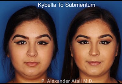 Kybella Before & After Gallery - Patient 24560867 - Image 1