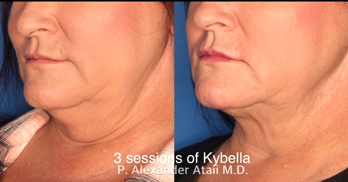Kybella Before & After Gallery - Patient 24560872 - Image 1