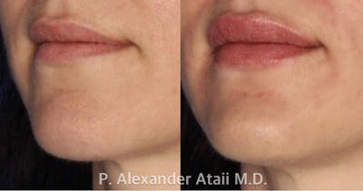 Dermal Fillers Gallery Before & After Gallery - Patient 111584 - Image 1