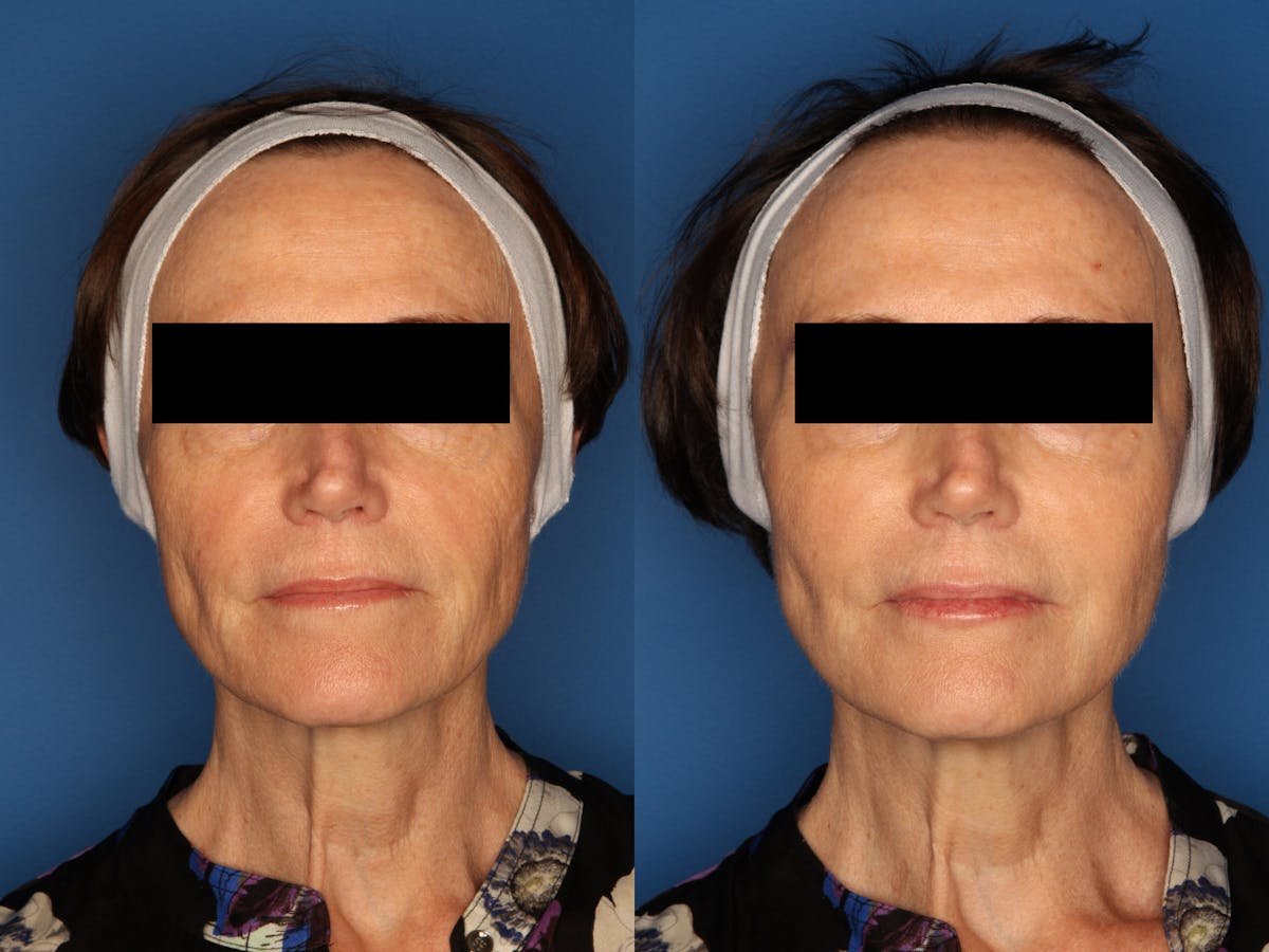 Sculptra Aesthetic Before & After Gallery - Patient 24560879 - Image 1