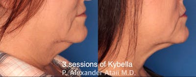 Kybella Gallery Before & After Gallery - Patient 24560874 - Image 1