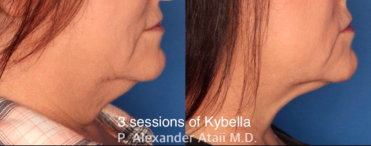 Kybella Before & After Gallery - Patient 24560874 - Image 1
