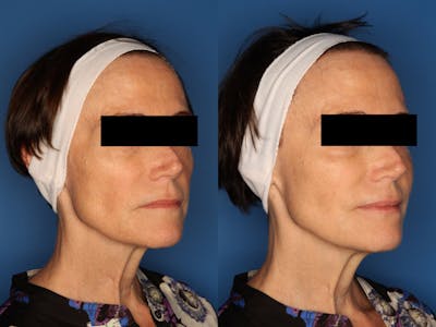 Sculptra Aesthetic Gallery Before & After Gallery - Patient 24560879 - Image 2