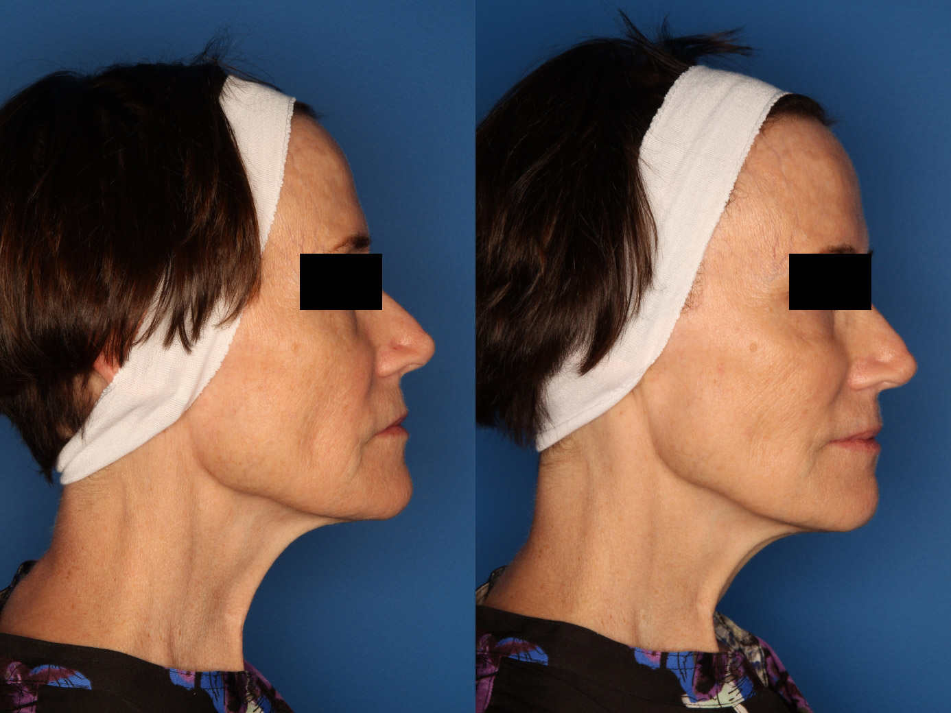 Sculptra Aesthetic Before & After Gallery - Patient 24560879 - Image 3
