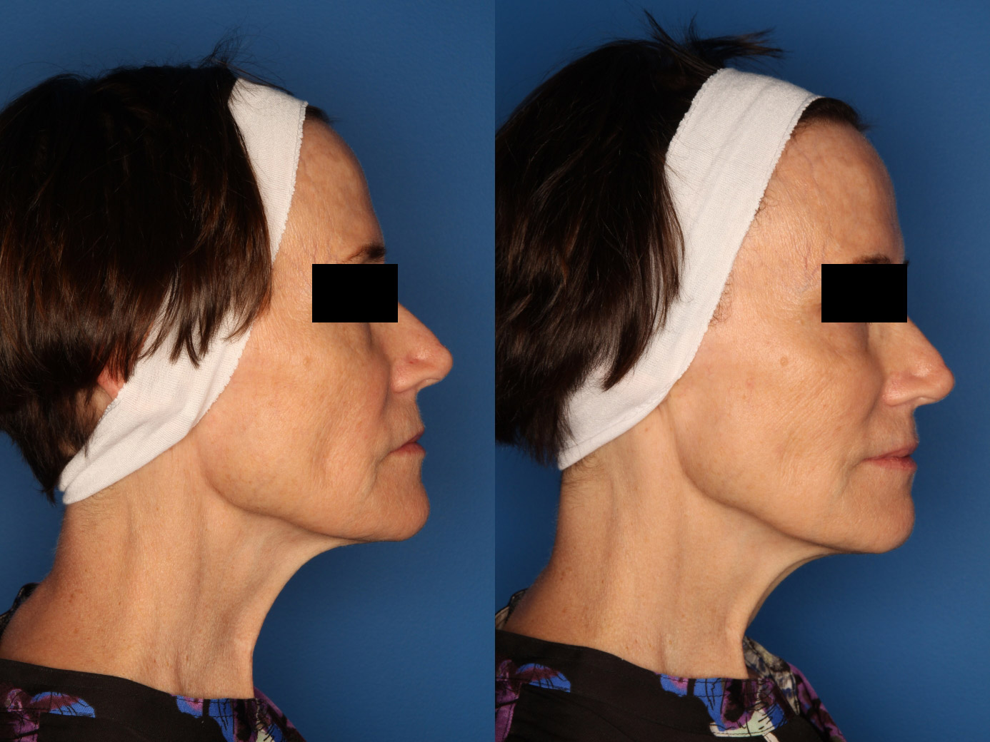 Sculptra Aesthetic Gallery Before & After Gallery - Patient 24560879 - Image 3