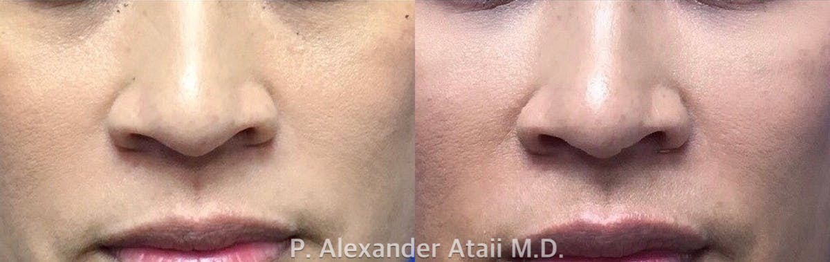 Dermal Fillers Gallery Before & After Gallery - Patient 379047 - Image 1