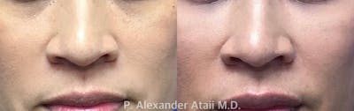 Juvederm Vollure Before & After Gallery - Patient 24560875 - Image 1