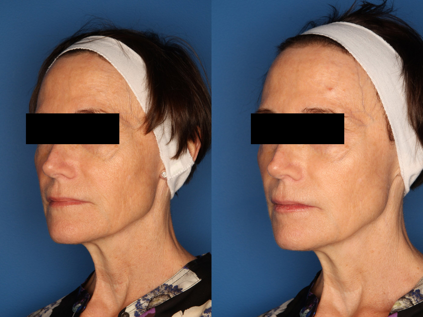 Sculptra Aesthetic Gallery Before & After Gallery - Patient 24560879 - Image 4