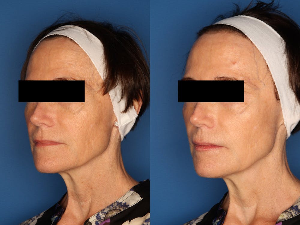 Sculptra Aesthetic Before & After Gallery - Patient 24560879 - Image 4