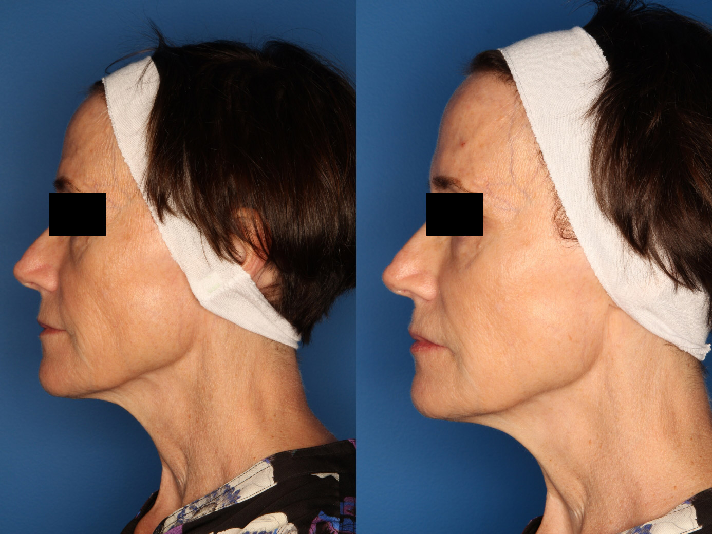 Sculptra Aesthetic Before & After Gallery - Patient 24560879 - Image 5