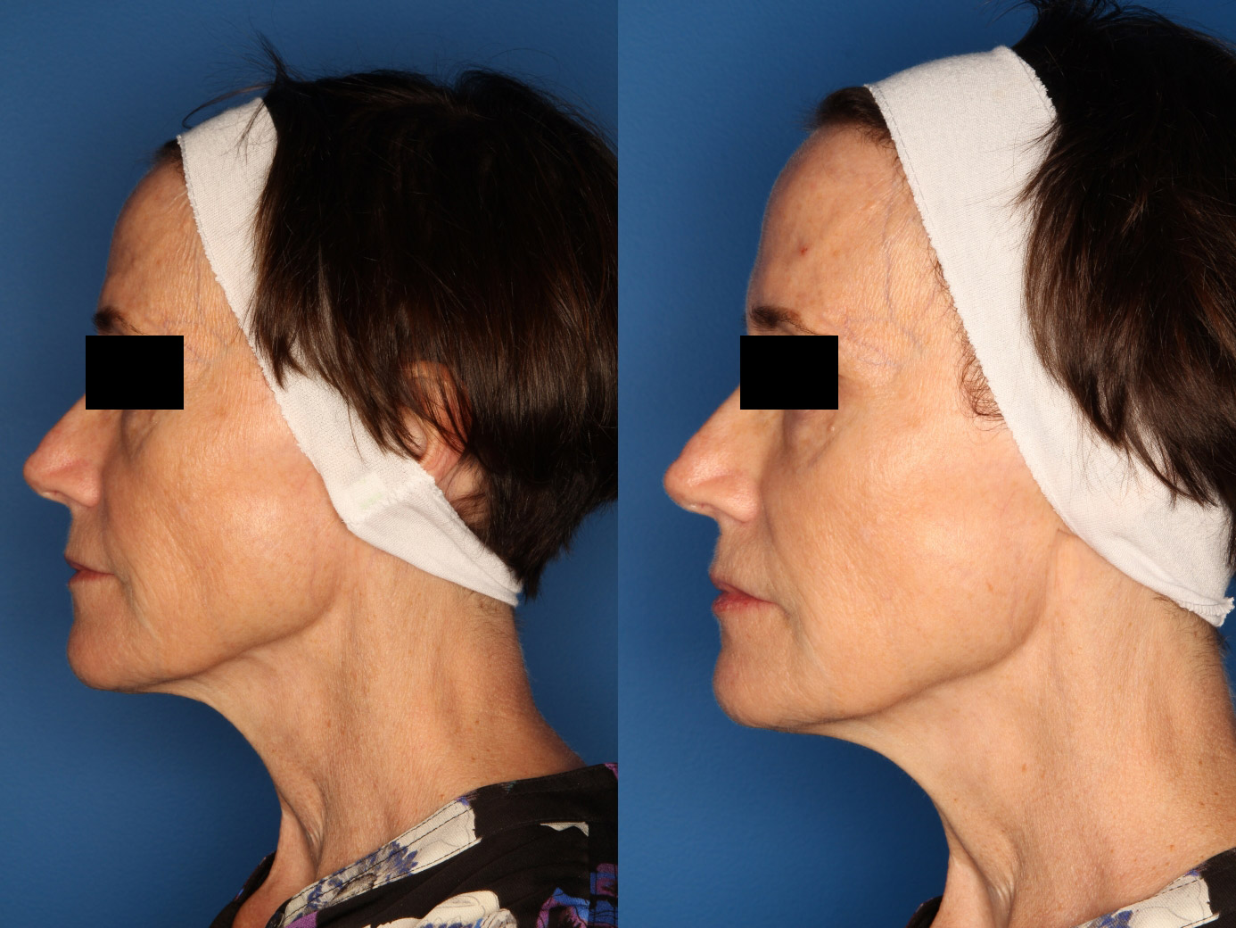 Sculptra Aesthetic Gallery Before & After Gallery - Patient 24560879 - Image 5