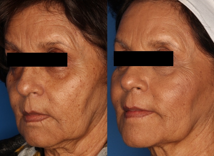 Dermal Fillers Before & After Gallery - Patient 145467 - Image 1