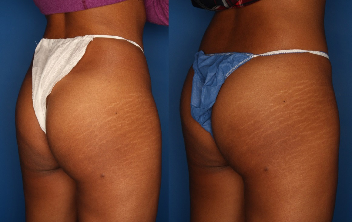 Sculptra Aesthetic Before & After Gallery - Patient 24560888 - Image 1