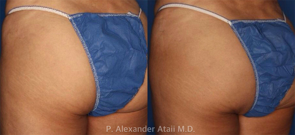 Sculptra Aesthetic Gallery Before & After Gallery - Patient 24560897 - Image 1